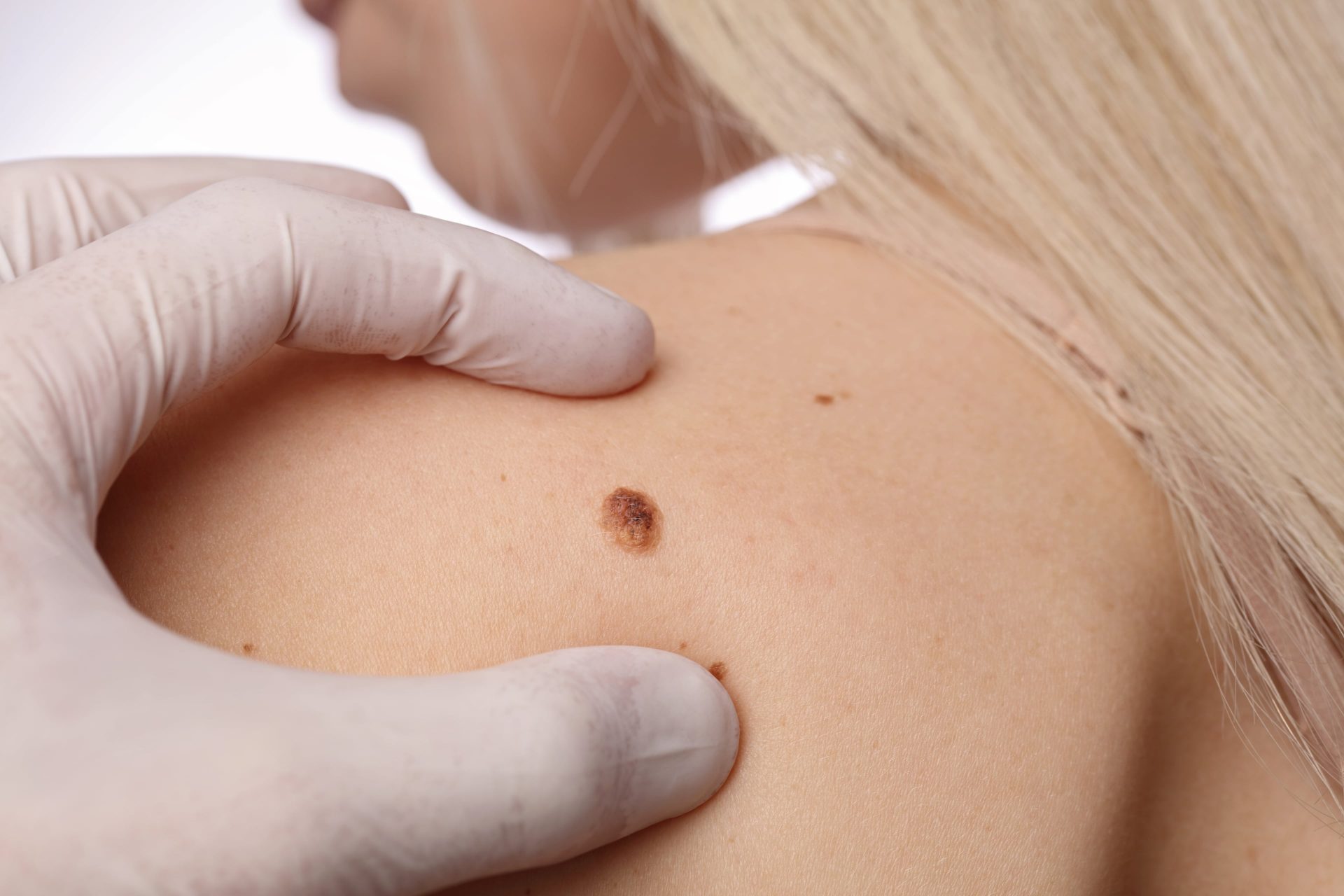 Вебинар «Разборы сложных клинических случаев лечения рака кожи»